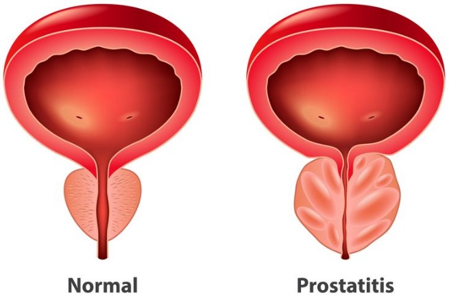 Prostatitis bisa Ganggu Kesuburan