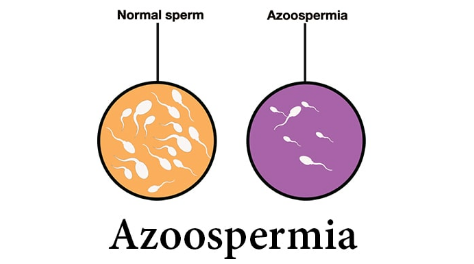Azoospermia pada Pria
